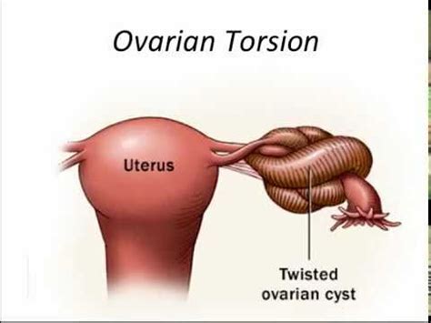 ovarian contortion